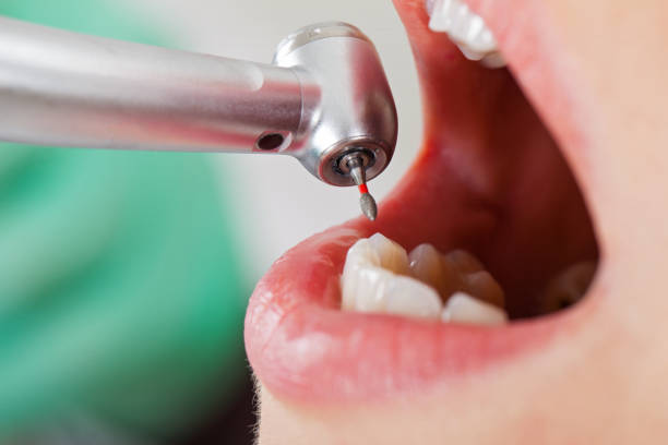 Best Chipped Tooth Repair Near Me  in Northwest Harbor, NY